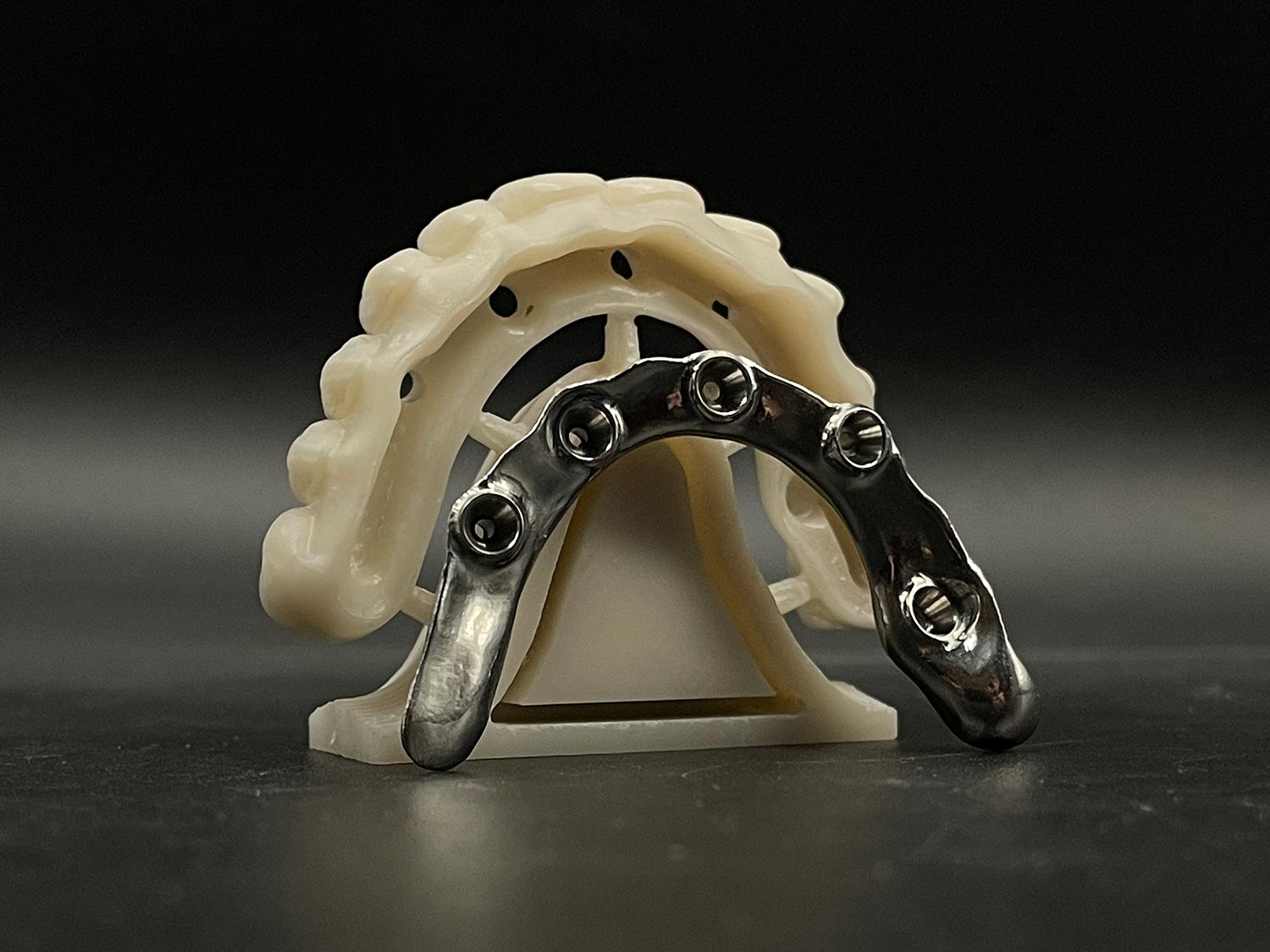 zirconia full contour fixed dentures implants screw retained bridge